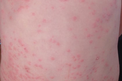 Two measles cases confirmed in Gwent says PHW