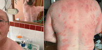 Brecon man survives more than 160 wasp stings thanks to MIU nurses