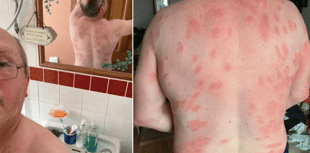 Brecon man survives more than 160 wasp stings thanks to MIU nurses