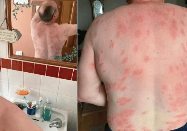 Brecon man survives more than 160 wasp stings thanks to MIU nurses